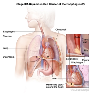 Stage IIIA squamous cell cancer of the esophagus (2); drawing shows the esophagus, trachea, and lung. The top inset shows cancer that has spread from the esophagus into the diaphragm and pleura; the aorta, chest wall, and rib are also shown. The bottom inset shows cancer that has spread from the esophagus into the membrane (sac) around the heart.