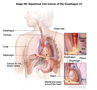 Stage IIIC squamous cell cancer of the esophagus (1); drawing shows the esophagus, trachea, and lung. The top inset shows cancer that has spread from the esophagus into the diaphragm and pleura; the aorta, chest wall, and rib are also shown. The bottom inset shows cancer that has spread from the esophagus into the membrane (sac) around the heart. Also shown is cancer in lymph nodes near the esophagus.
