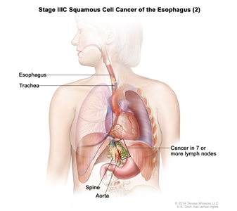 Stage IIIC squamous cell cancer of the esophagus (2); drawing shows cancer that has spread from the esophagus into the trachea, aorta, and spine. Also shown is cancer in lymph nodes near the esophagus.