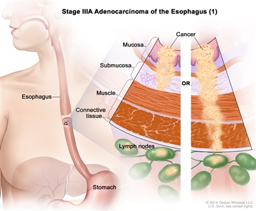 Stage IIIA adenocarcinoma of the esophagus (1); drawing shows the esophagus and stomach. A two-panel inset shows the layers of the esophagus wall: the mucosa, submucosa, muscle, and connective tissue layers. The left panel shows cancer in the mucosa and submucosa layers and in 3 lymph nodes. The right panel shows cancer in the mucosa, submucosa, muscle, and connective tissue layers and in 1 lymph node.
