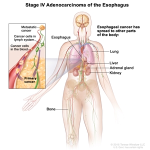 Stage IV adenocarcinoma of the esophagus; drawing shows other parts of the body where esophagus cancer may spread, including the lung, liver, adrenal gland, kidney, and bone. An inset shows cancer cells spreading from the esophagus, through the blood and lymph system, to another part of the body where metastatic cancer has formed.