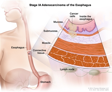 Stage IA adenocarcinoma of the esophagus; drawing shows the esophagus and stomach. An inset shows cancer cells in the mucosa and submucosa layers of the esophagus wall. Also shown are the muscle and connective tissue layers of the esophagus wall and lymph nodes.