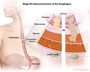 Stage IB adenocarcinoma of the esophagus; drawing shows the esophagus and stomach. A two-panel inset shows the layers of the esophagus wall: the mucosa, submucosa, muscle, and connective tissue layers. Also shown are lymph nodes. The left panel shows cancer in the mucosa and submucosa layers. The right panel shows cancer in the mucosa, submucosa, and muscle layers.