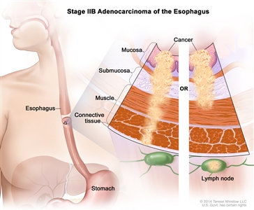 Stage IIB adenocarcinoma of the esophagus; drawing shows the esophagus and stomach. A two-panel inset shows the layers of the esophagus wall: the mucosa, submucosa, muscle, and connective tissue layers. The left panel shows cancer in the mucosa, submucosa, muscle, and connective tissue layers. The right panel shows cancer in the mucosa, submucosa, and muscle layers and in 1 lymph node.