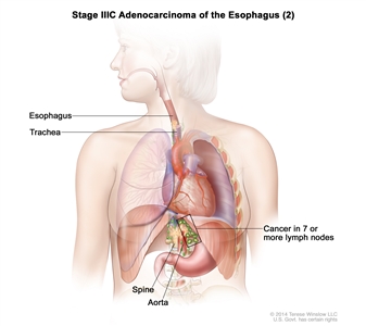 Stage IIIC adenocarcinoma of the esophagus (2); drawing shows cancer that has spread from the esophagus into the trachea, aorta, and spine. Also shown is cancer in lymph nodes near the esophagus.