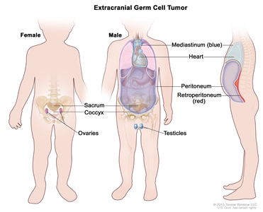 Extracranial germ cell tumor; drawing shows parts of the body where extracranial germ cell tumors may form, including the mediastinum (the area between the lungs), retroperitoneum (the area behind the abdominal organs), sacrum, coccyx, testicles (in males), and ovaries (in females). Also shown are the heart and peritoneum.