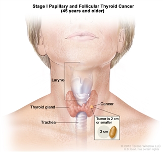 Stage I papillary and follicular thyroid cancer in patients 45 years and older; drawing shows cancer in the thyroid gland. The tumor is 2 centimeters or smaller. Also shown are the larynx and trachea.