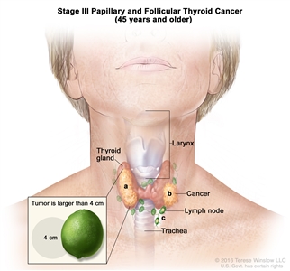 Stage III papillary and follicular thyroid cancer in patients 45 years and older; drawing shows (a) cancer in the thyroid gland and the tumor is larger than 4 centimeters; (b) cancer has spread to tissues just outside the thyroid gland; and (c) cancer has spread to lymph nodes near the trachea. Also shown is the larynx.