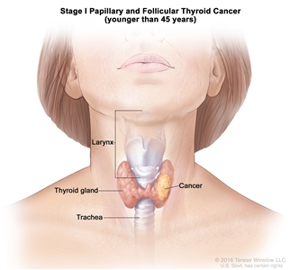 Stage I papillary and follicular thyroid cancer in patients younger than 45 years; drawing shows cancer in the thyroid gland. Also shown are the larynx and trachea.