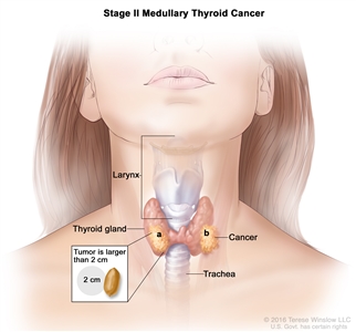 Stage II medullary thyroid cancer; drawing shows (a) cancer in the thyroid gland and the tumor is larger than 2 centimeters and (b) cancer has spread to tissues just outside the thyroid gland. Also shown are the larynx and trachea.