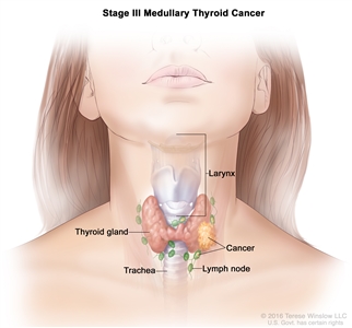 Stage III medullary thyroid cancer; drawing shows cancer that has spread to tissues just outside the thyroid gland and to lymph nodes near the trachea and larynx.