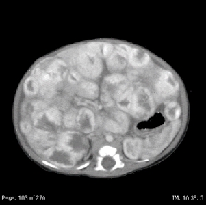 MRI image of a diffuse infantile hemangioma with diffuse liver lesions.
