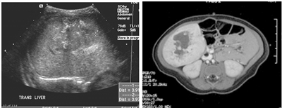 Ultrasound image of an intrahepatic congenital hemangioma with a single liver lesion (left panel) and an MRI image of the same lesion with early peripheral enhancement (right panel).