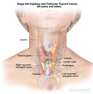 Stage IVA papillary and follicular thyroid cancer in patients 45 years and older; drawing shows cancer that has spread from the thyroid gland to the larynx, the esophagus, the left recurrent laryngeal nerve, the trachea, and a lymph node on one side of the neck. Also shown is the right recurrent laryngeal nerve.