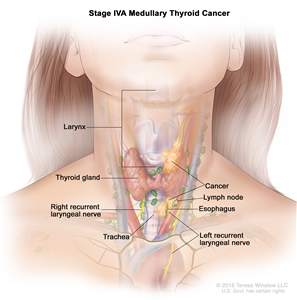 Stage IVA medullary thyroid cancer; drawing shows cancer that has spread from the thyroid gland to the larynx, the esophagus, the left recurrent laryngeal nerve, the trachea, and a lymph node on one side of the neck. Also shown is the right recurrent laryngeal nerve.