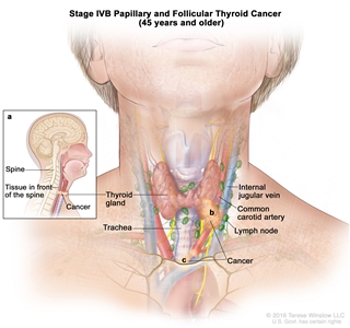 Stage IVB papillary and follicular thyroid cancer in patients 45 years and older; drawing shows cancer that has spread from the thyroid gland to tissue in front of the spine and has surrounded the common carotid artery and the blood vessels in the area between the lungs. Also shown are the internal jugular vein, lymph nodes, and trachea.