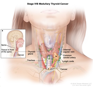 Stage IVB medullary thyroid cancer; drawing shows cancer that has spread from the thyroid gland to tissue in front of the spine and has surrounded the common carotid artery and the blood vessels in the area between the lungs. Also shown are the internal jugular vein, lymph nodes, and trachea.