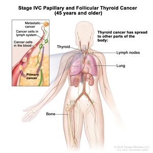 Stage IVC papillary and follicular thyroid cancer in patients 45 years and older; drawing show other parts of the body where thyroid cancer may spread, including the lymph nodes, lung, and bone. An inset shows cancer cells spreading from the thyroid, through the blood and lymph system, to another part of the body where metastatic cancer has formed.