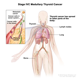 Stage IVC medullary thyroid cancer; drawing shows other parts of the body where thyroid cancer may spread, including the lymph nodes, lung, and bone. An inset shows cancer cells spreading from the thyroid, through the blood and lymph system, to another part of the body where metastatic cancer has formed.