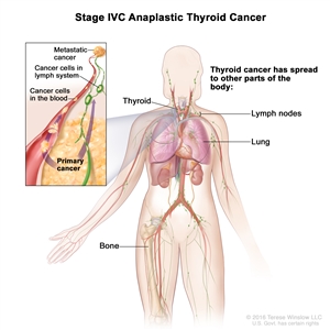 Stage IVC anaplastic thyroid cancer; drawing shows other parts of the body where thyroid cancer may spread, including the lymph nodes, lung, and bone. An inset shows cancer cells spreading from the thyroid, through the blood and lymph system, to another part of the body where metastatic cancer has formed.