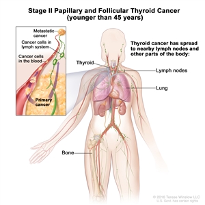 Stage II papillary and follicular thyroid cancer in patients younger than 45 years; drawing shows other parts of the body where thyroid cancer may spread, including the lymph nodes, lung, and bone. An inset shows cancer cells spreading from the thyroid, through the blood and lymph system, to another part of the body where metastatic cancer has formed.