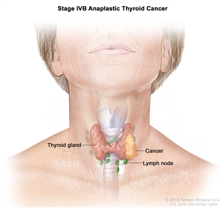 Stage IVB anaplastic thyroid cancer; drawing shows cancer that has spread to tissue just outside the thyroid gland. The lymph nodes are also shown.